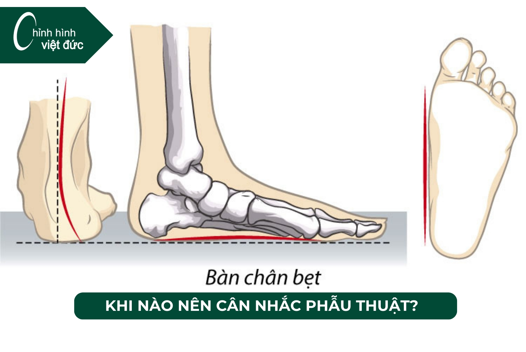 mổ bàn chân bẹt