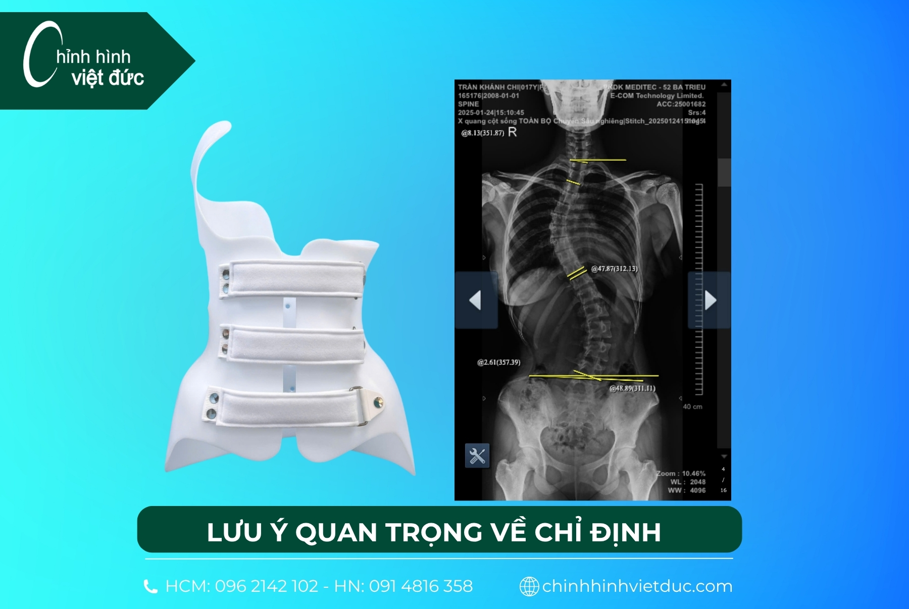 áo chỉnh hình 3d