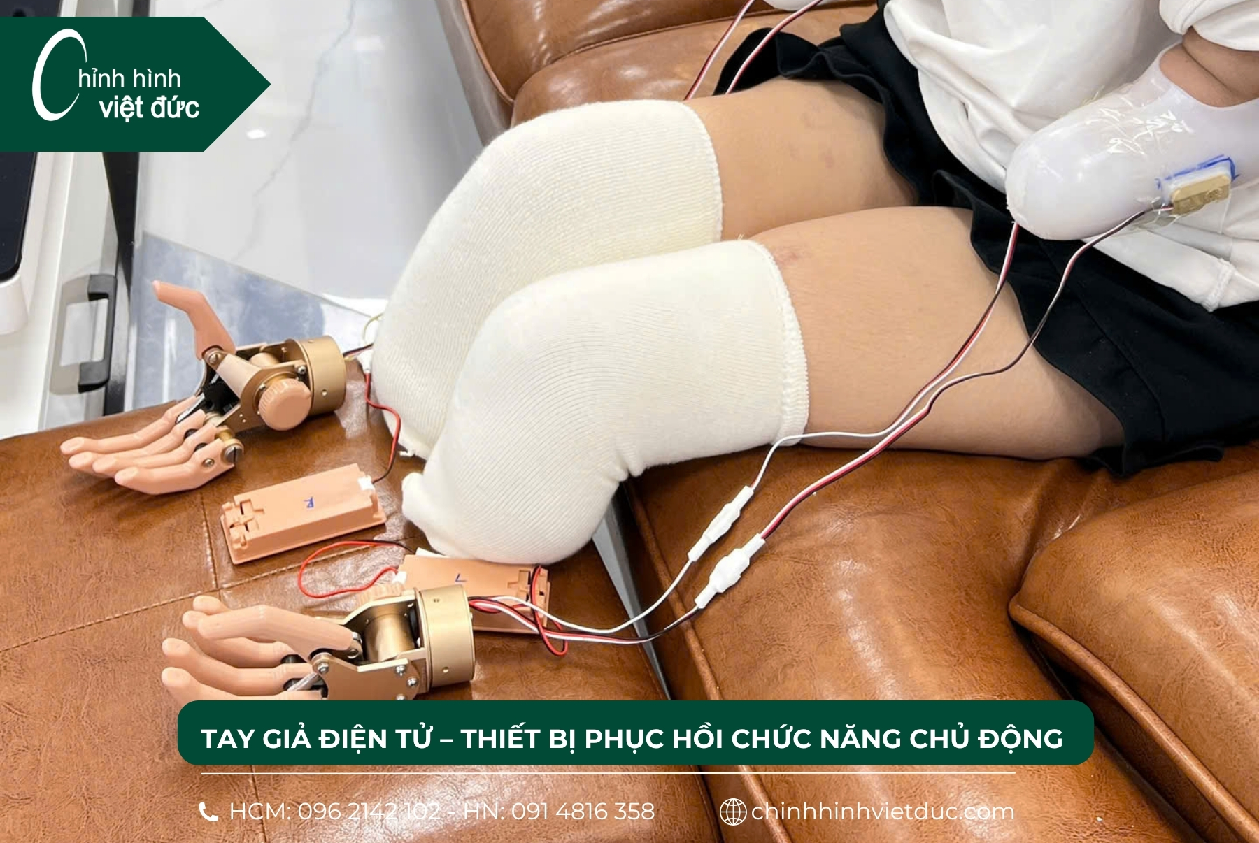 hai tay giả điện tử