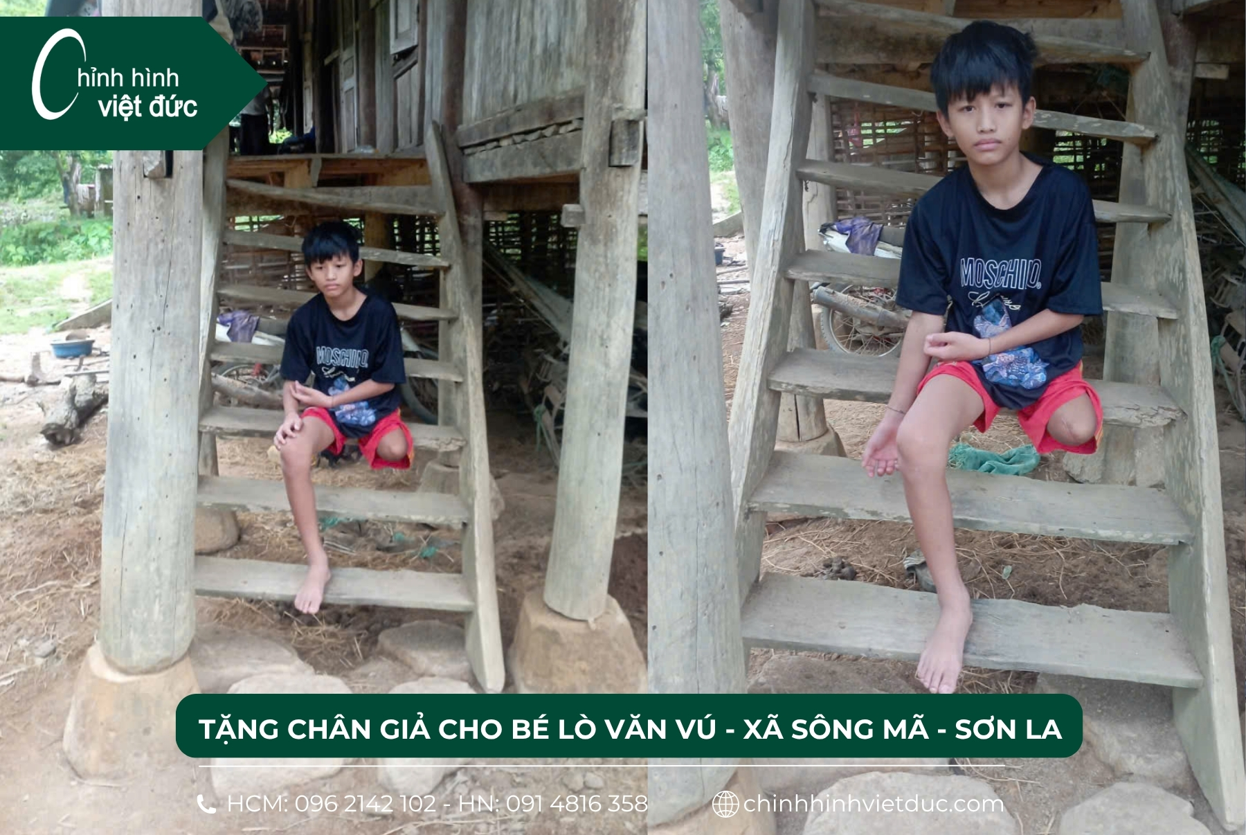 tặng chân giả