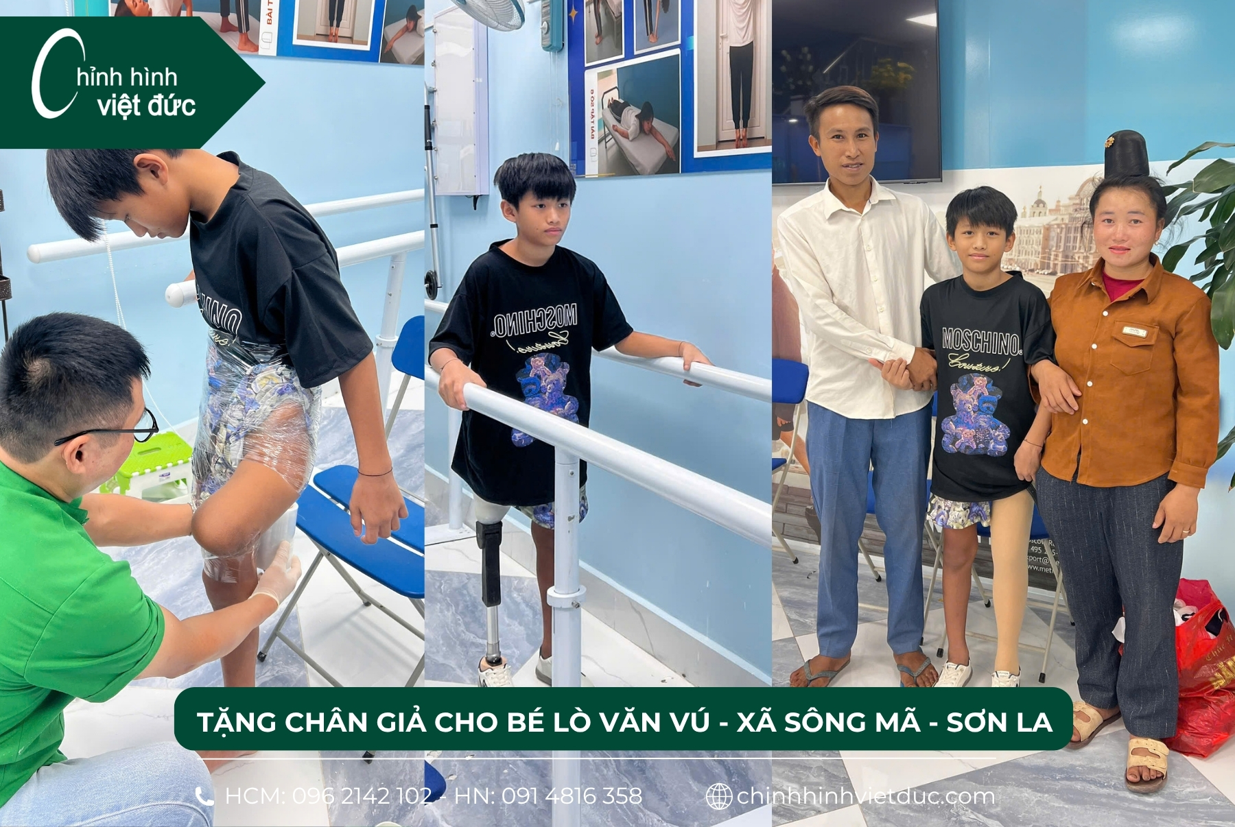 tặng chân giả 