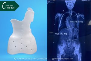 Áo nẹp chỉnh hình cho trẻ vị thành niên