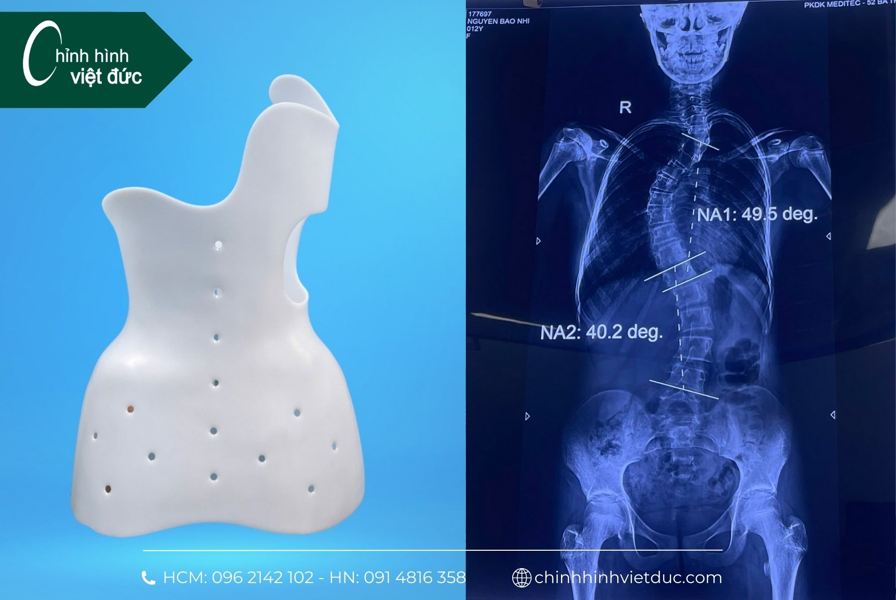 áo nẹp chỉnh hình