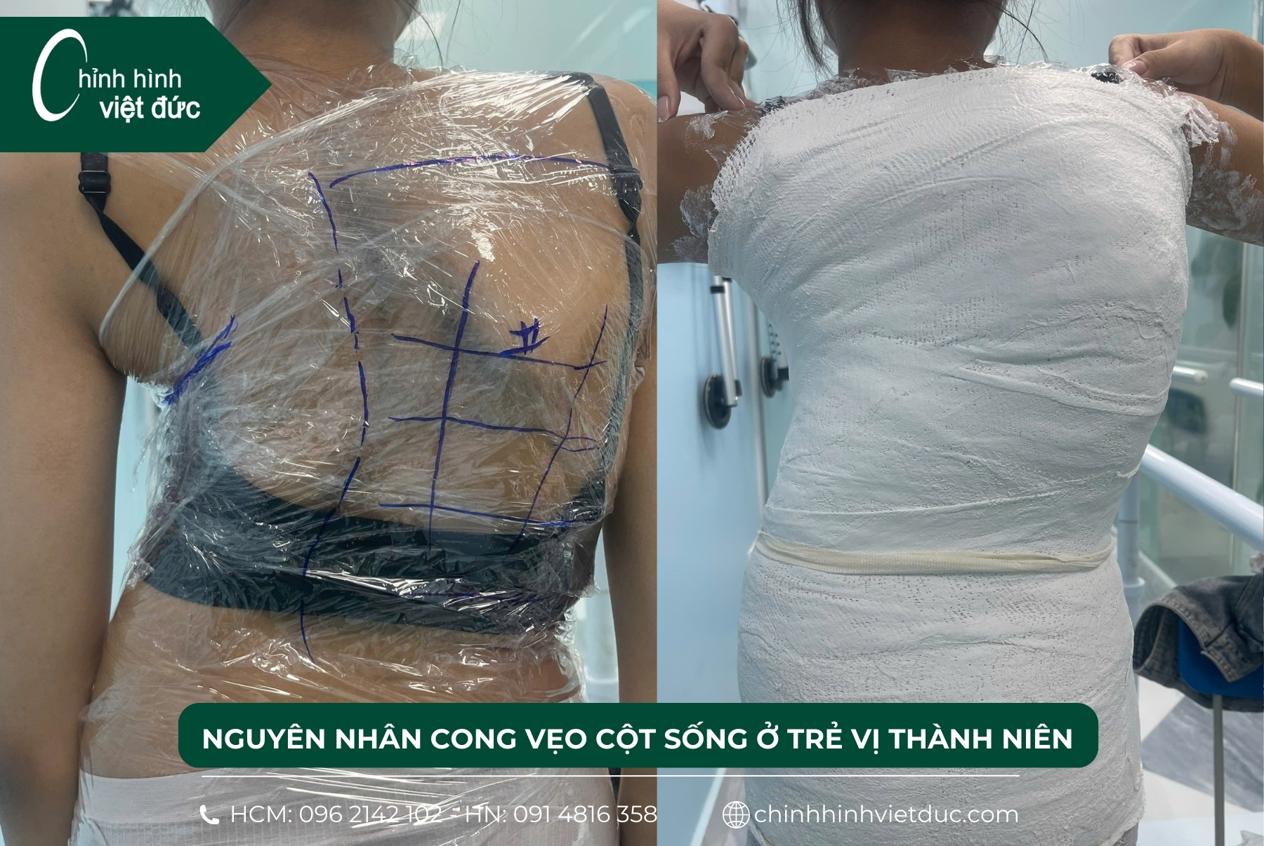 nguyên nhân cong vẹo cột sống