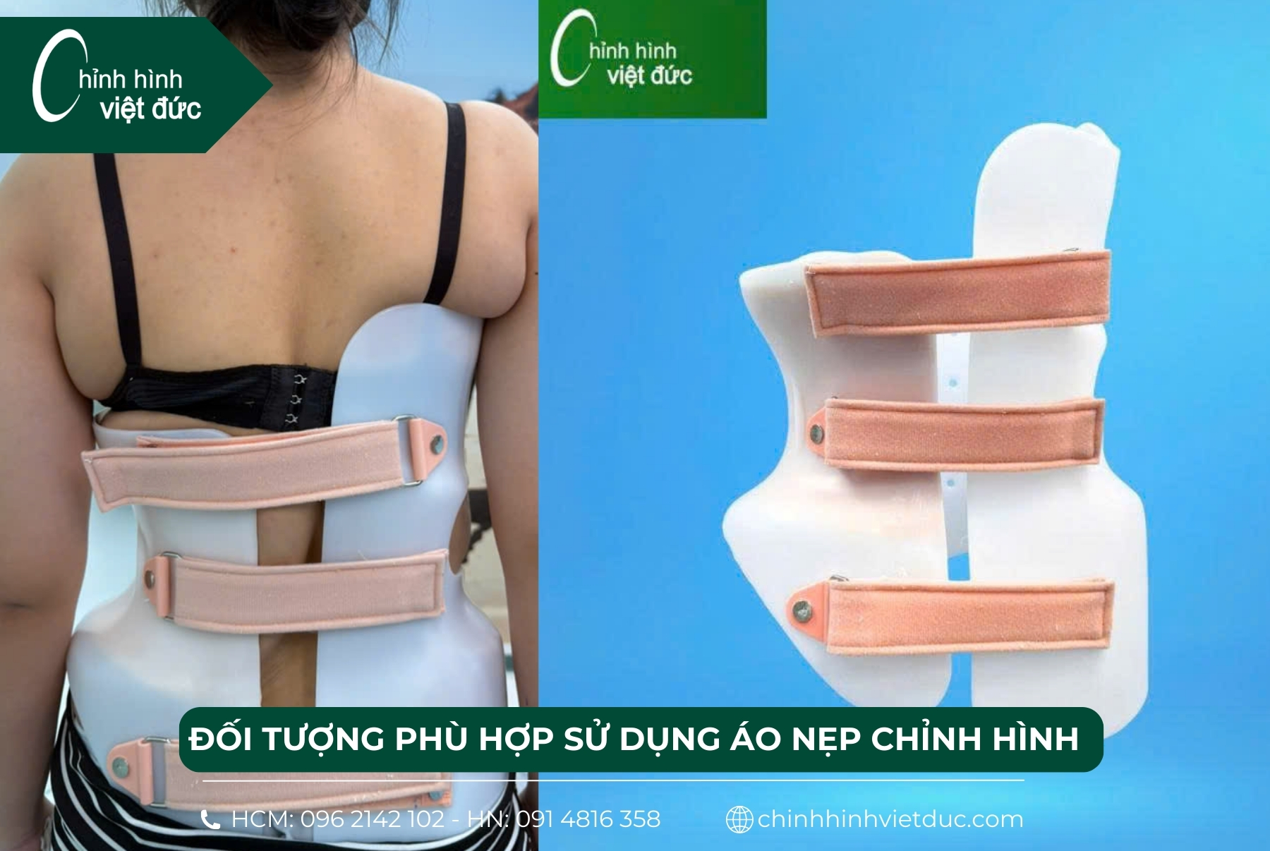 đối tượng sử dụng áo nẹp chỉnh hình