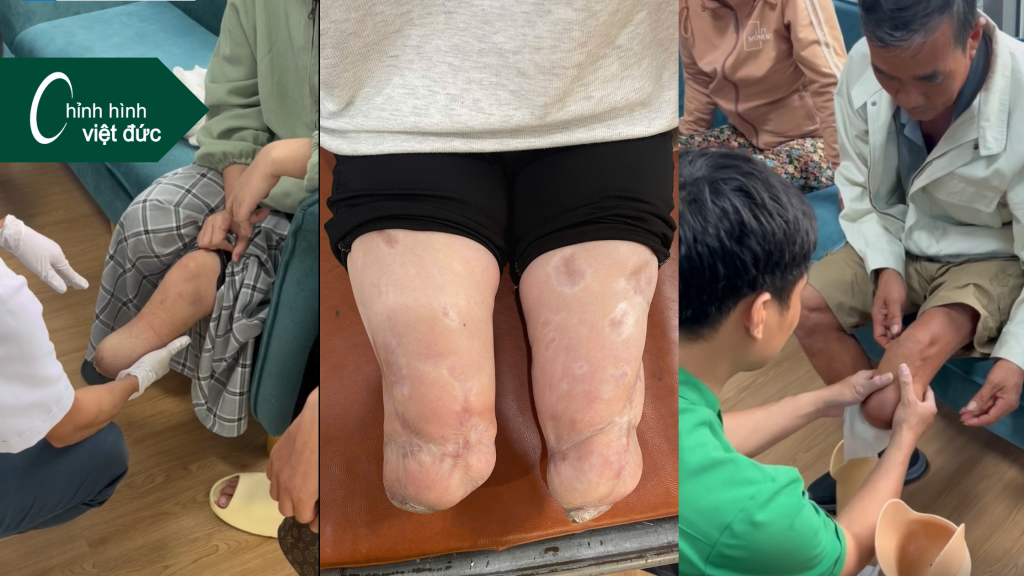 Cắt bao lâu thì lắp được chân giả?