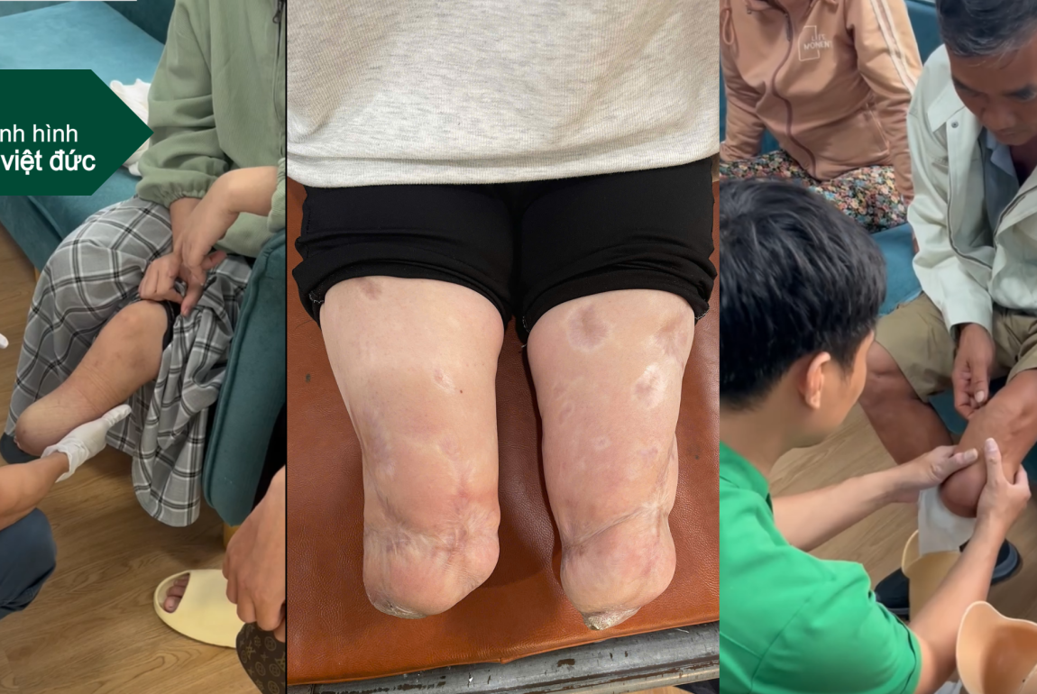 cắt bao lâu thì lắp được chân giả