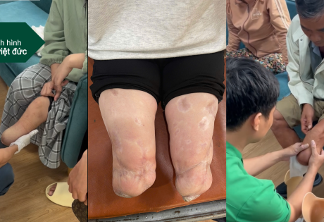 cắt bao lâu thì lắp được chân giả