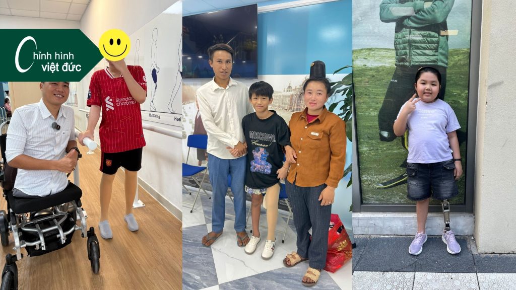 6 điều cần biết khi lựa chọn chân giả trẻ em