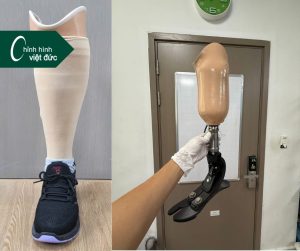 Chân giả dưới gối giá bao nhiêu? Thông tin chi tiết cập nhật mới nhất 2025