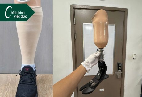 chi phí lắp chân giả dưới gối