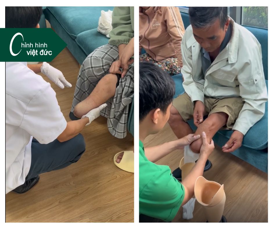 thời gian lắp chân dưới gối