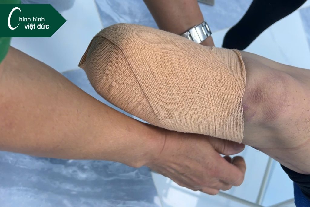 Tại sao cần cuốn băng chun cho mỏm cụt