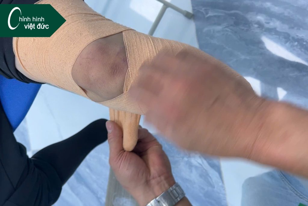 Tại sao cần cuốn băng chun cho mỏm cụt