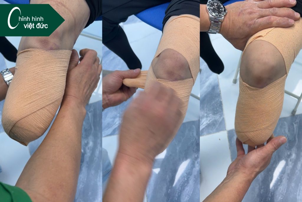 Tại sao cần cuốn băng chun cho mỏm cụt?