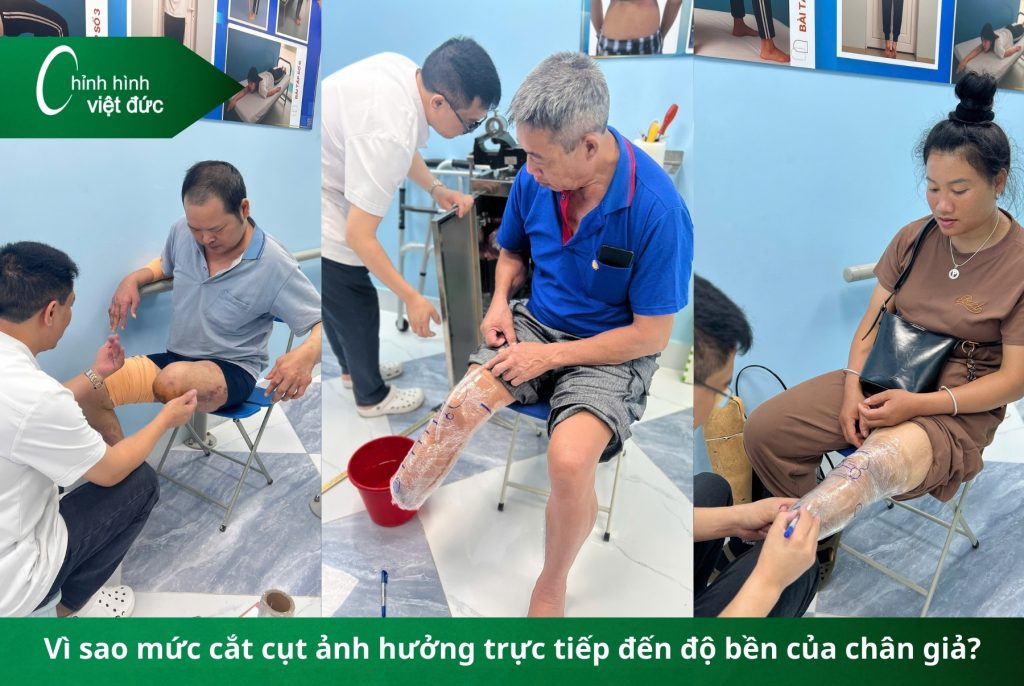 Bí kíp giữ chân giả bền đẹp cho từng loại cắt cụt