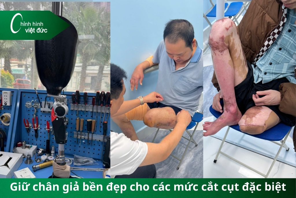 Bí kíp giữ chân giả bền đẹp cho từng loại cắt cụt