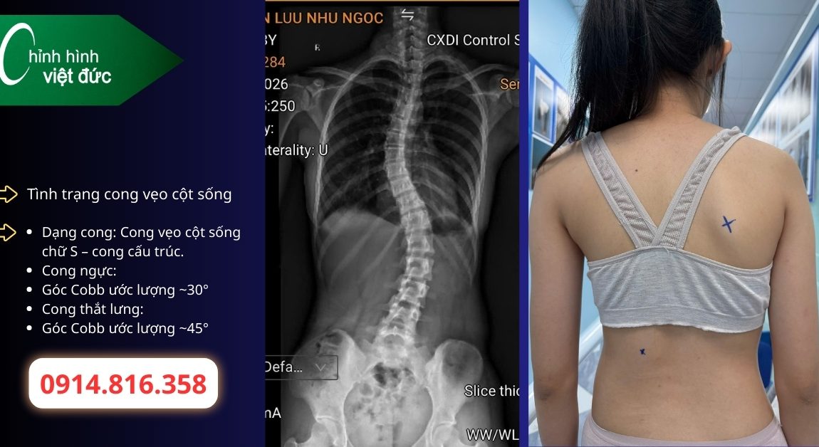 Khi nào cong thắt lưng cần mặc áo chỉnh hình