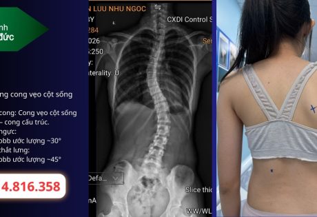 Khi nào cong thắt lưng cần mặc áo chỉnh hình