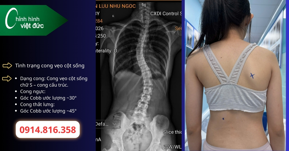 Khi nào cong thắt lưng cần mặc áo chỉnh hình