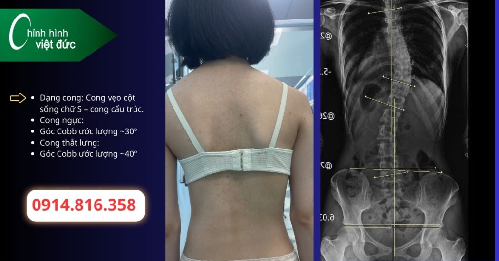 Khi nào cong thắt lưng cần mặc áo chỉnh hình