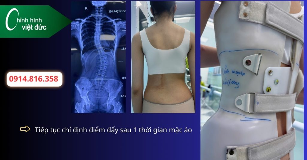 Khi nào cong thắt lưng cần mặc áo chỉnh hình