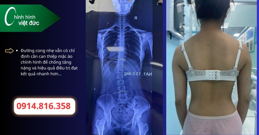 Khi nào cong thắt lưng cần mặc áo chỉnh hình