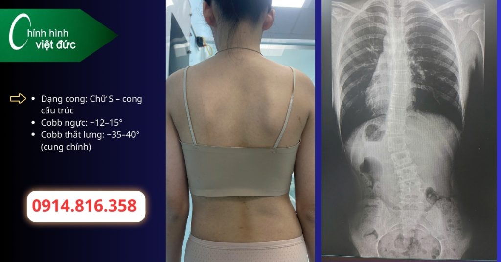 Khi nào cong thắt lưng cần mặc áo chỉnh hình