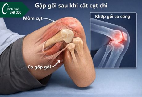 Tại sao tình trạng gập gối lại ảnh hưởng đến lắp chân giả