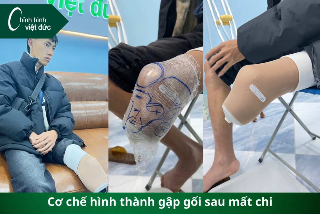 Tại sao tình trạng gập gối lại ảnh hưởng đến lắp chân giả
