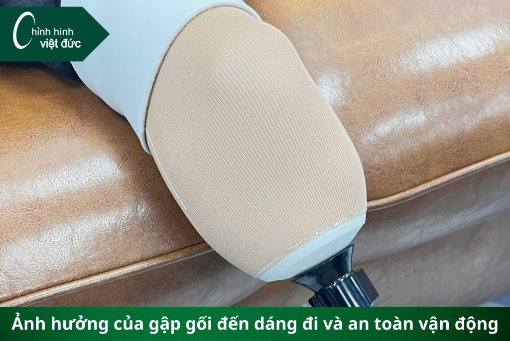 Tại sao tình trạng gập gối lại ảnh hưởng đến lắp chân giả