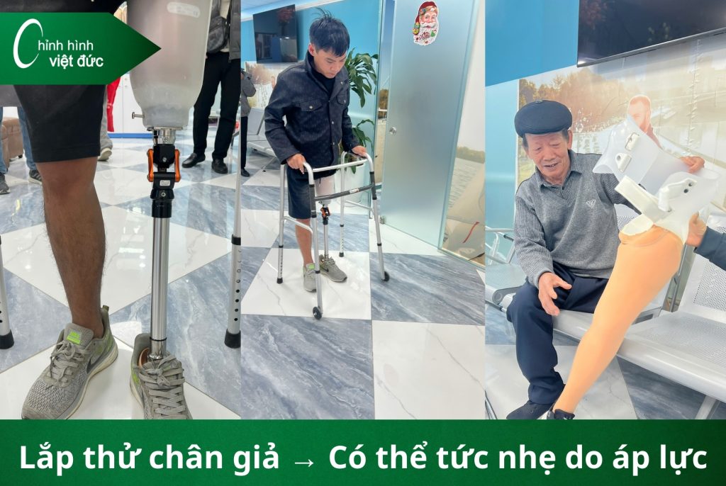 làm chân giả có đau không