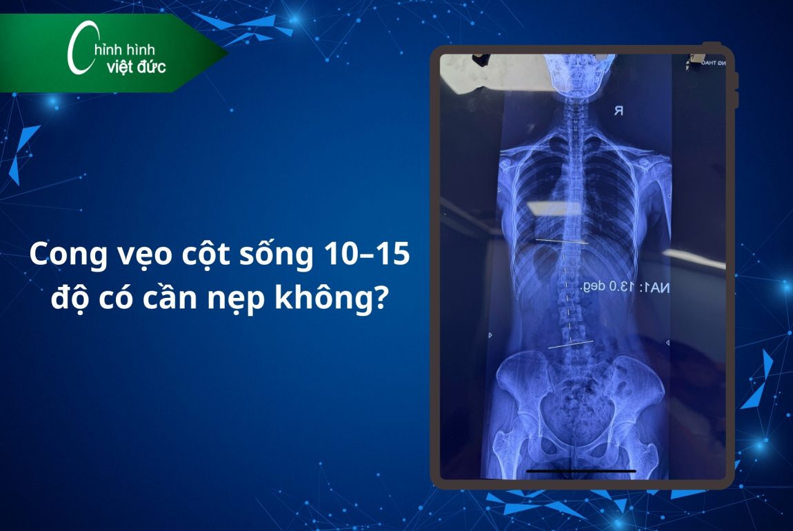 Cong vẹo cột sống 10–15 độ có cần nẹp không