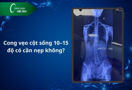 Cong vẹo cột sống 10–15 độ có cần nẹp không