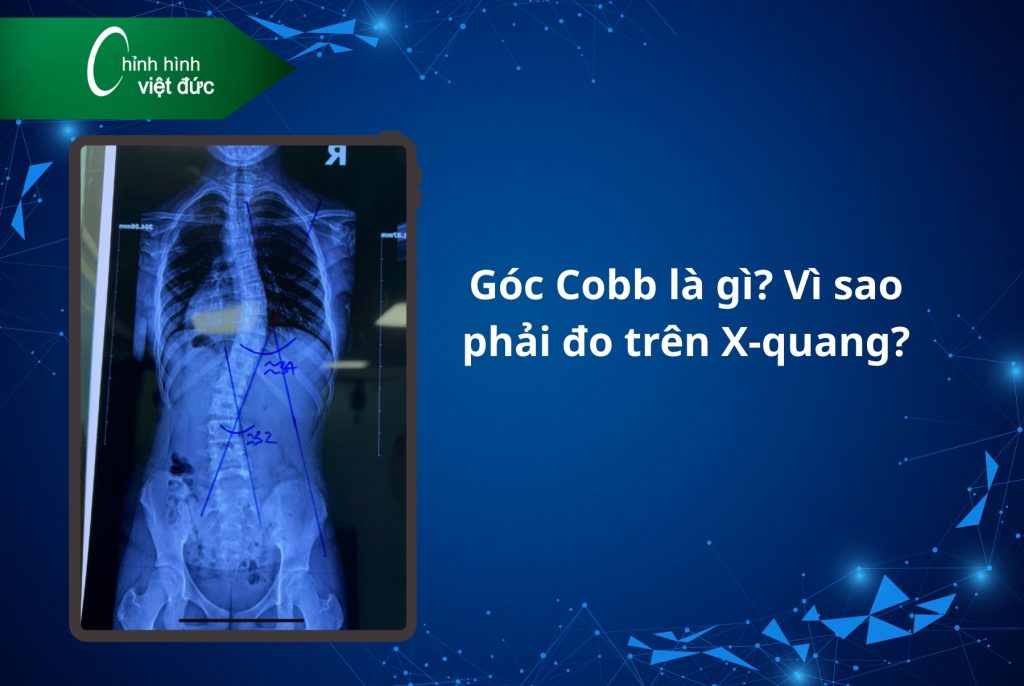 Cong vẹo cột sống 10–15 độ có cần nẹp không