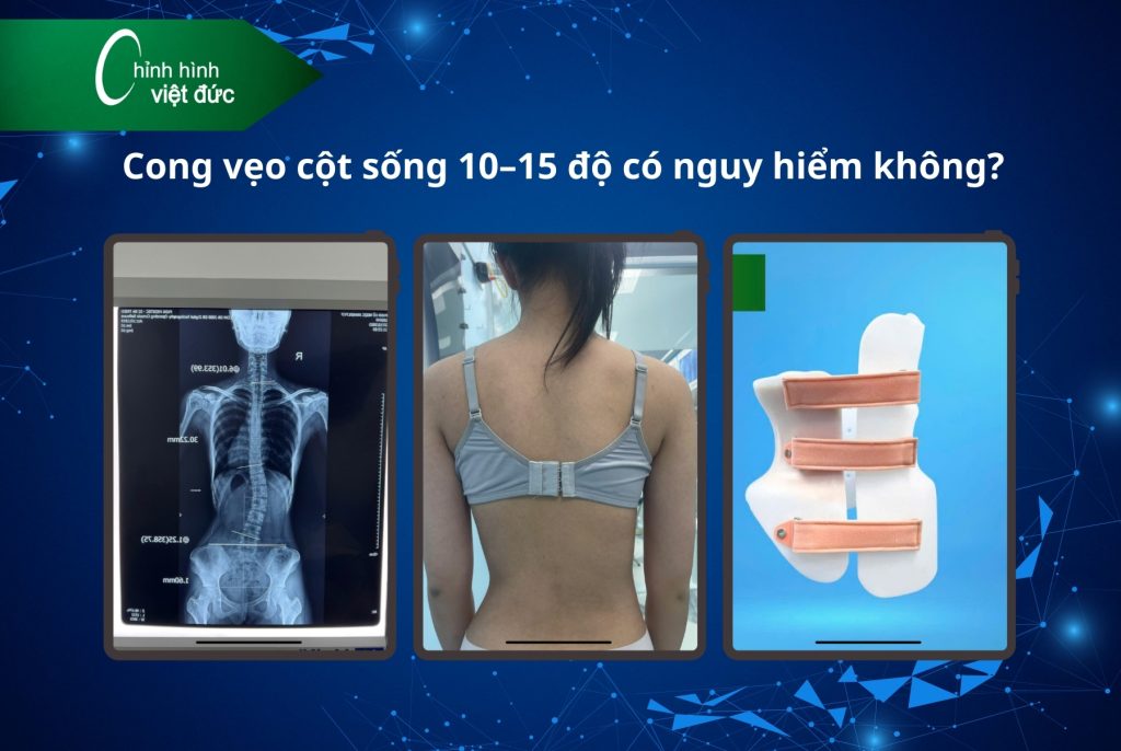 Cong vẹo cột sống 10–15 độ có cần nẹp không