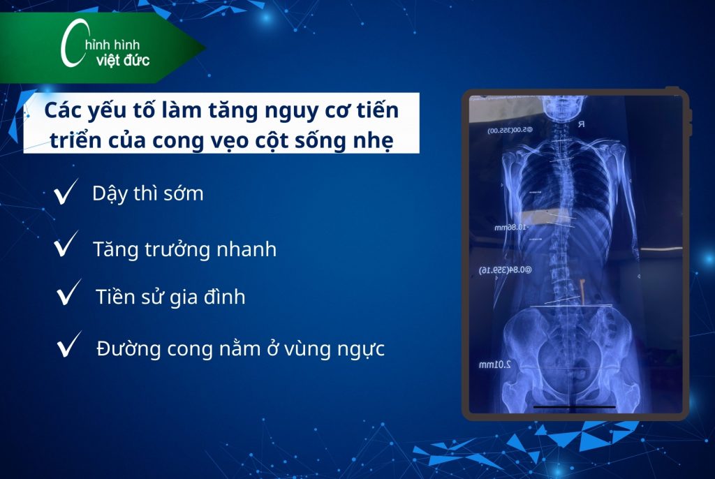 Cong vẹo cột sống 10–15 độ có cần nẹp không