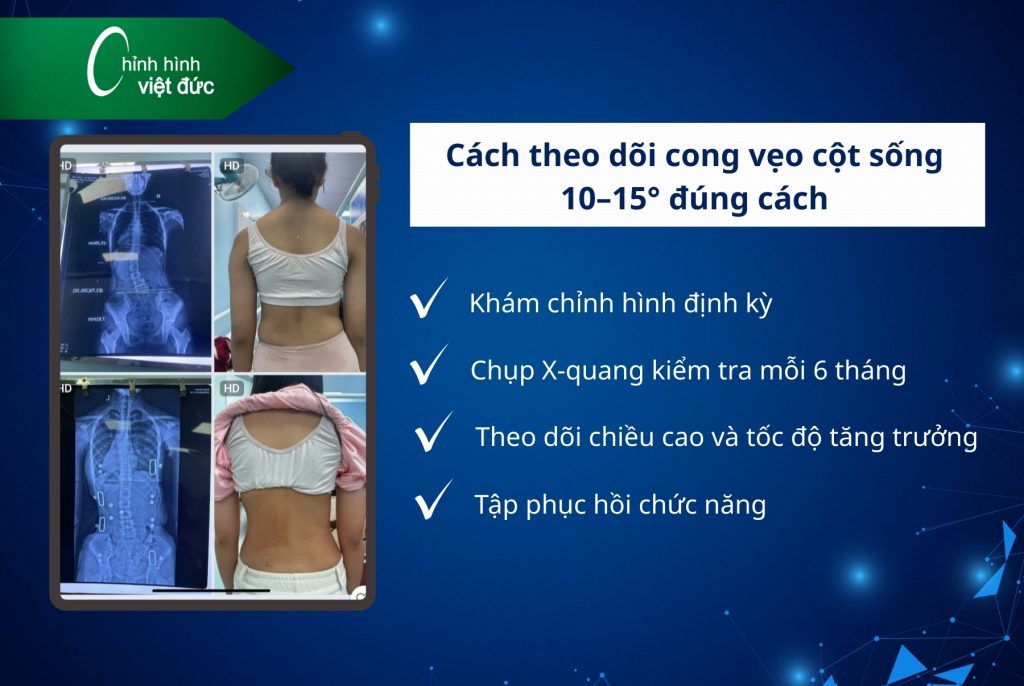 Cong vẹo cột sống 10–15 độ có cần nẹp không