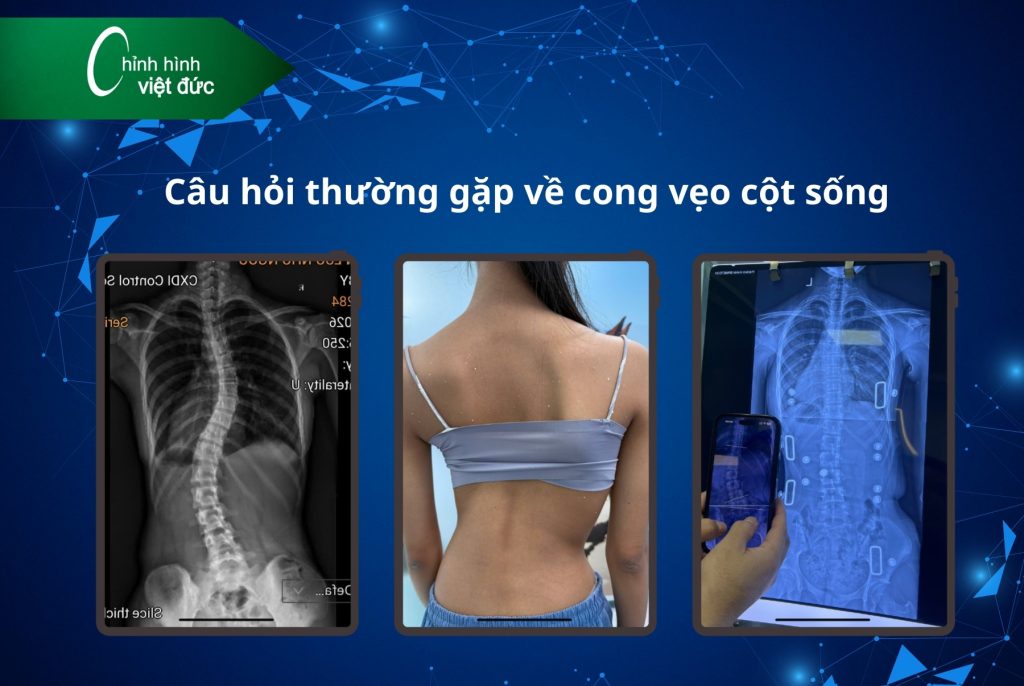 Cong vẹo cột sống 10–15 độ có cần nẹp không