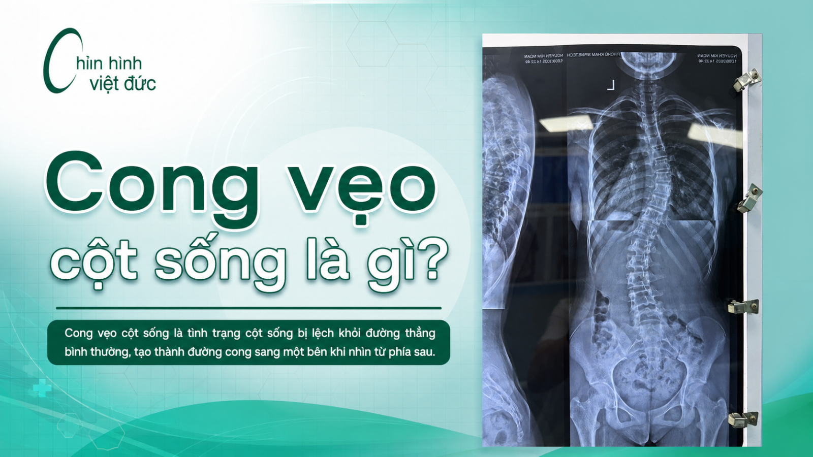 áo chỉnh hình