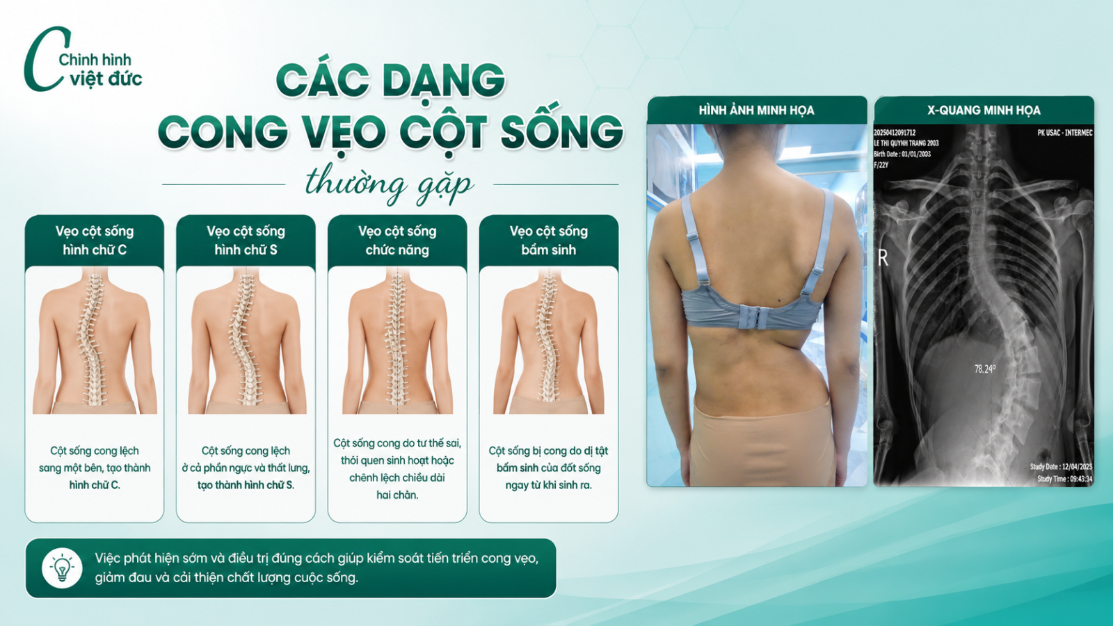 áo chỉnh hình cong vẹo cột sống