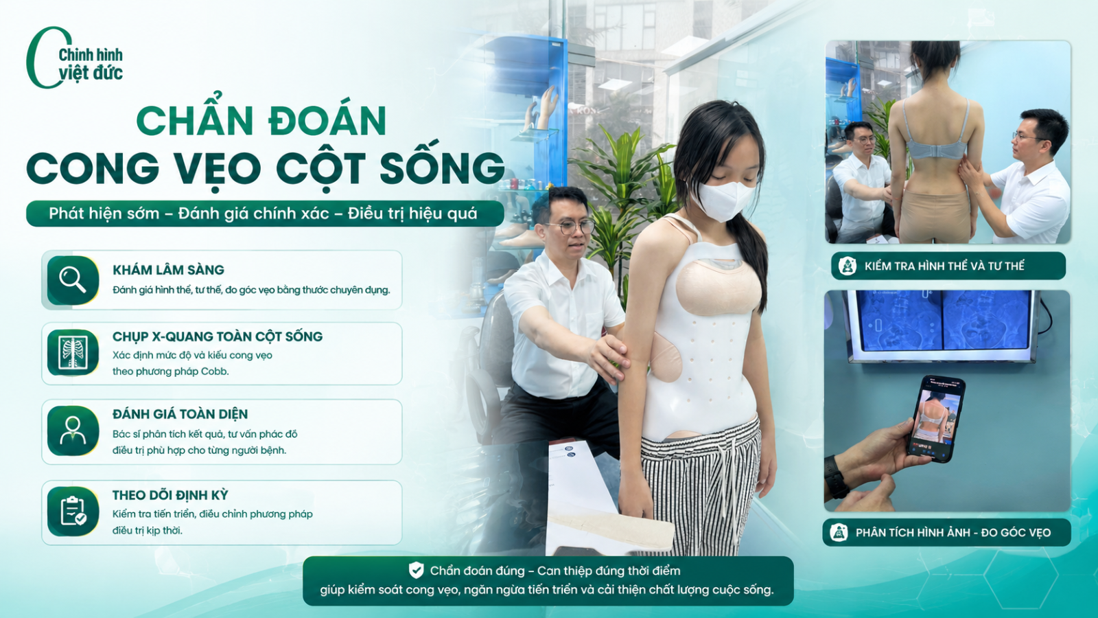 áo chỉnh hình cong vẹo cột sống 