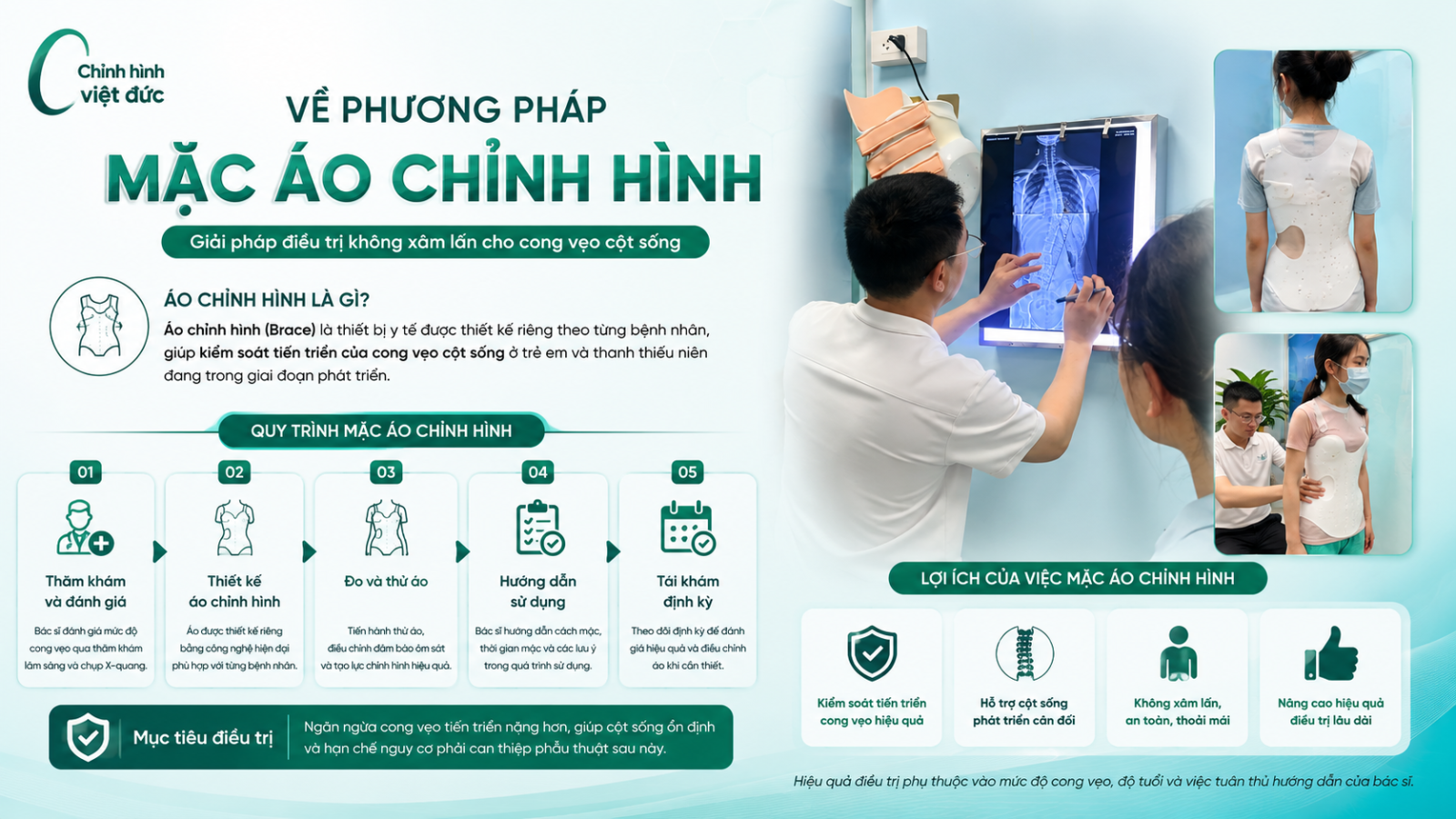 áo chỉnh hình cong vẹo cột sống 
