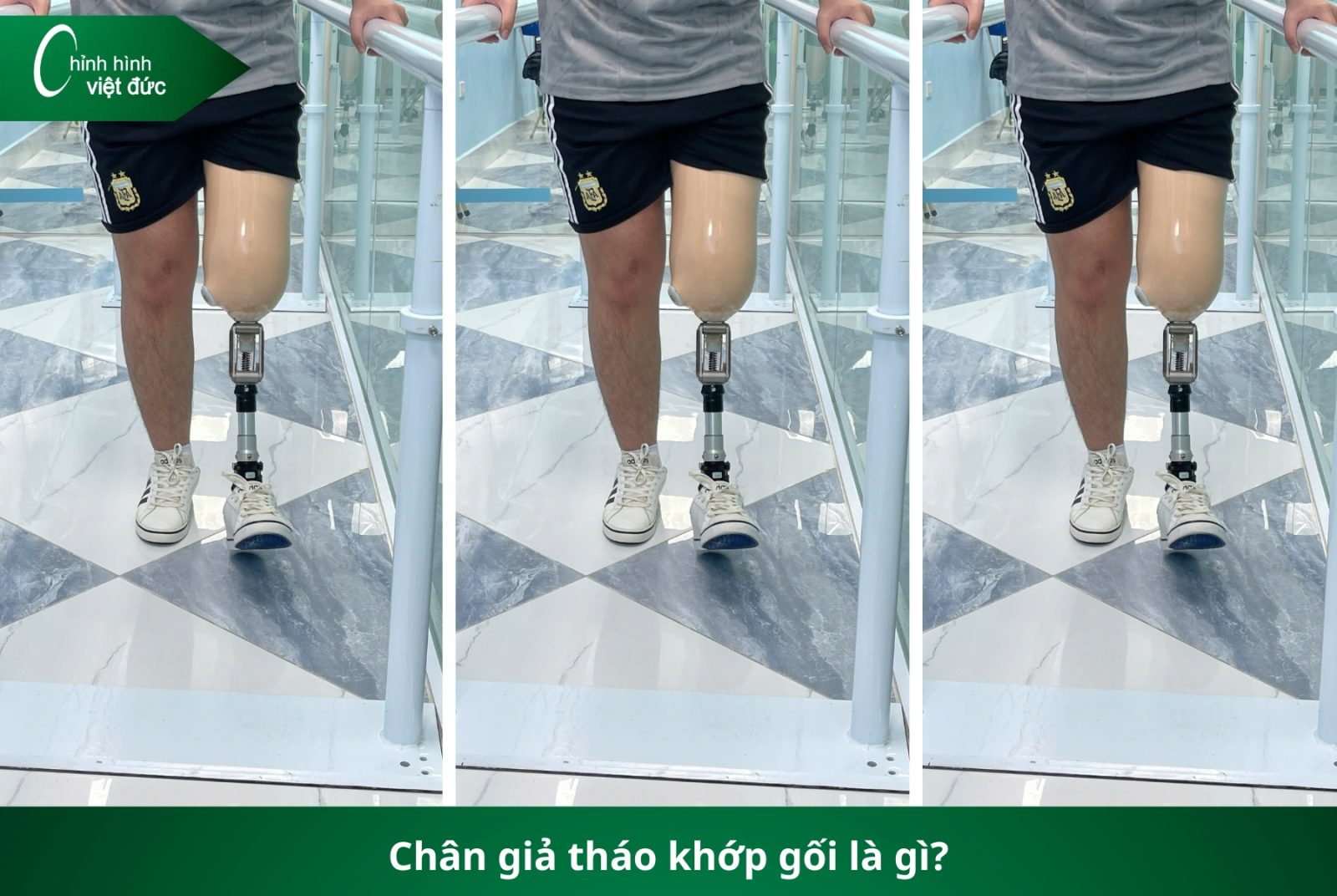 Các Loại Chân Giả Hiện Nay: Nên Chọn Loại Nào Phù Hợp