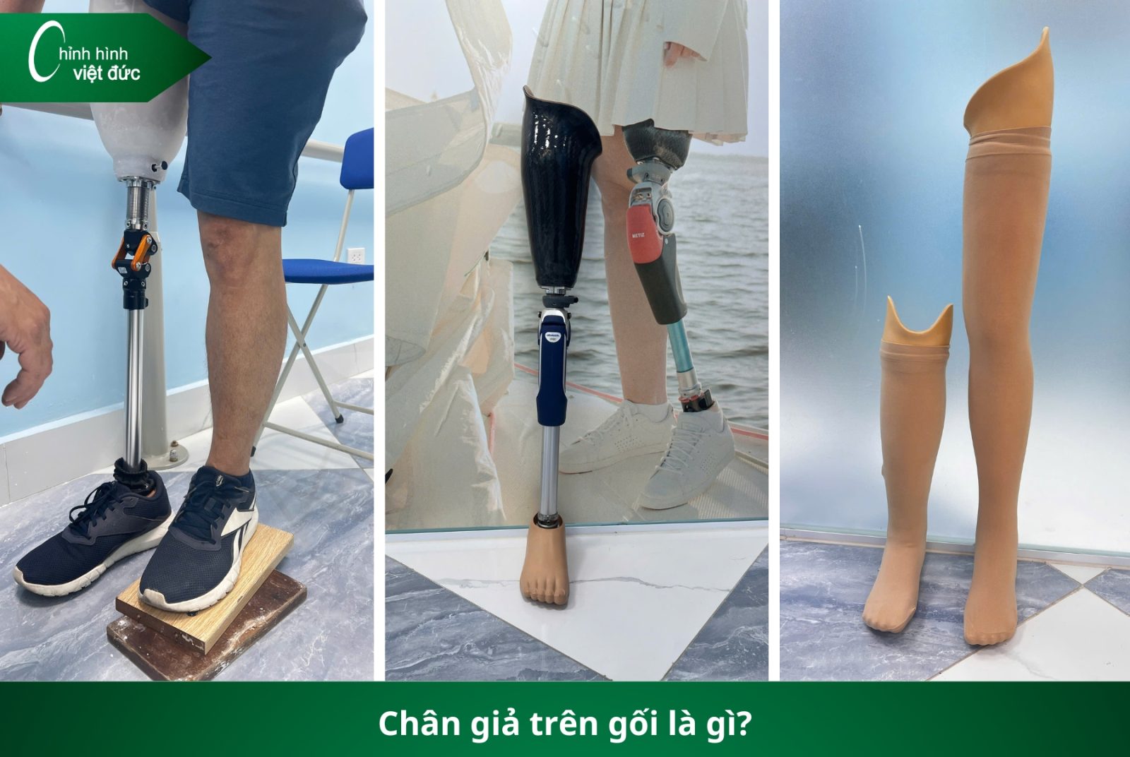 Các Loại Chân Giả Hiện Nay: Nên Chọn Loại Nào Phù Hợp