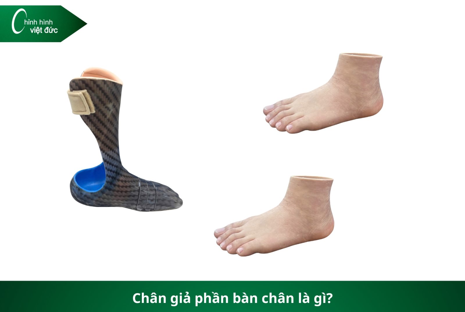 Các Loại Chân Giả Hiện Nay: Nên Chọn Loại Nào Phù Hợp