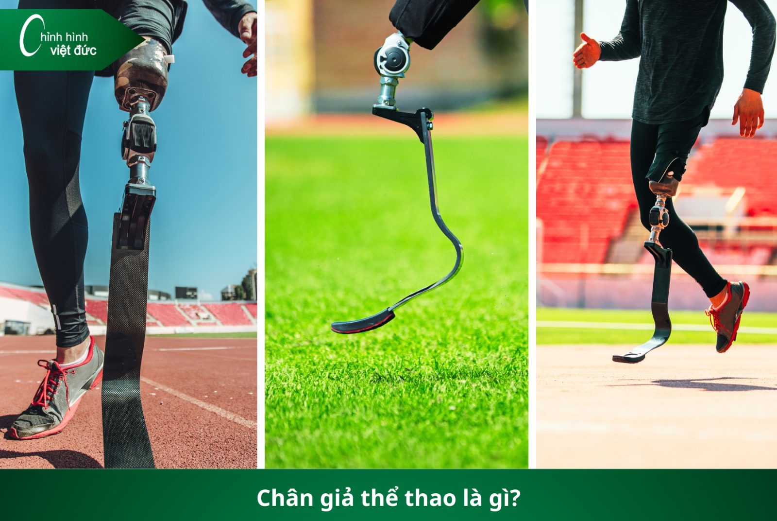 Các Loại Chân Giả Hiện Nay: Nên Chọn Loại Nào Phù Hợp