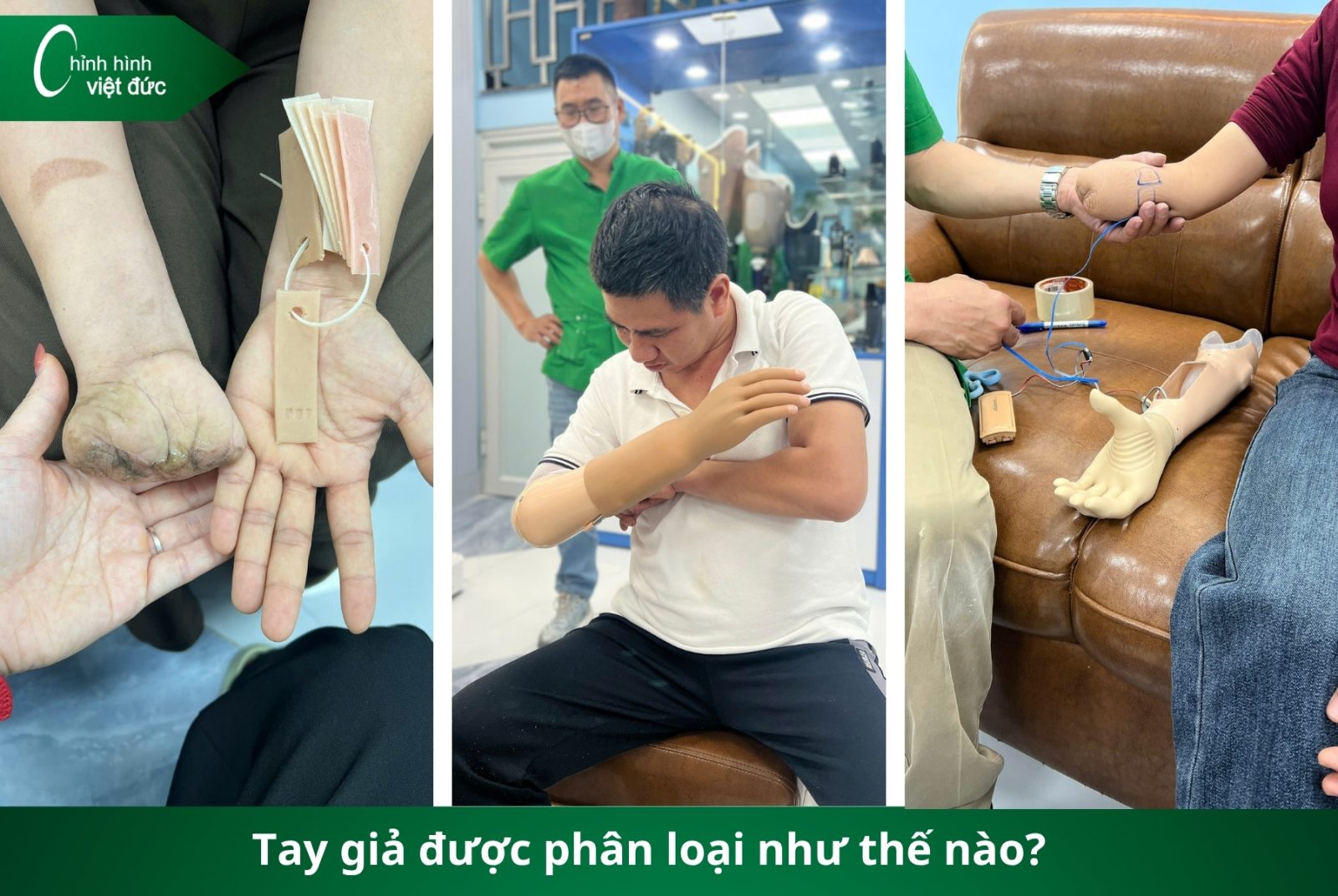 Các Loại Tay Giả Hiện Nay  Phân Loại Và Cách Chọn Phù Hợp