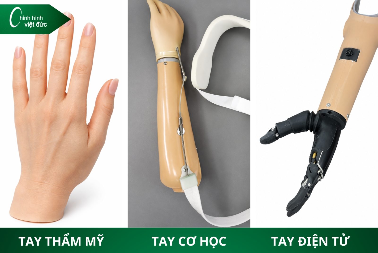 Các Loại Tay Giả Hiện Nay  Phân Loại Và Cách Chọn Phù Hợp