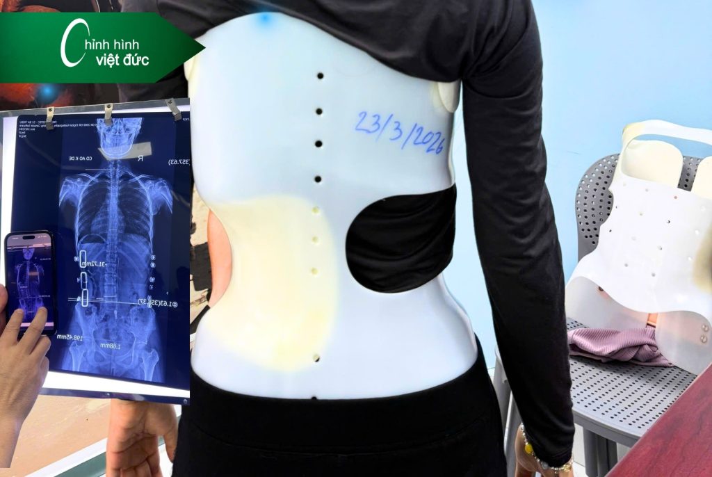 Địa chỉ làm áo chỉnh cong vẹo Hà Nội